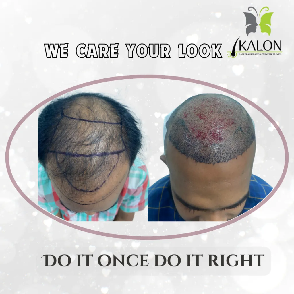 Best Hair Transplant Clinic in Visakhapatnam