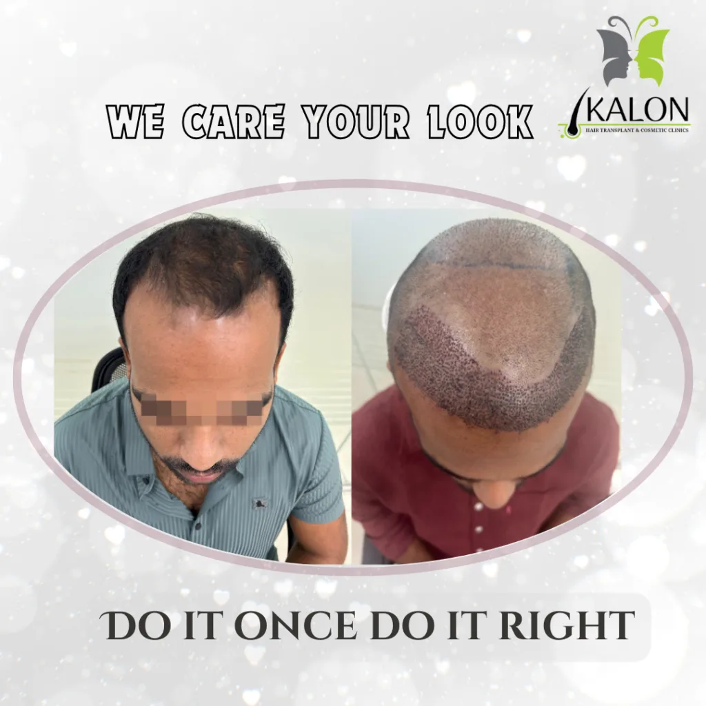 best hair transplant clinic in visakhapatnam