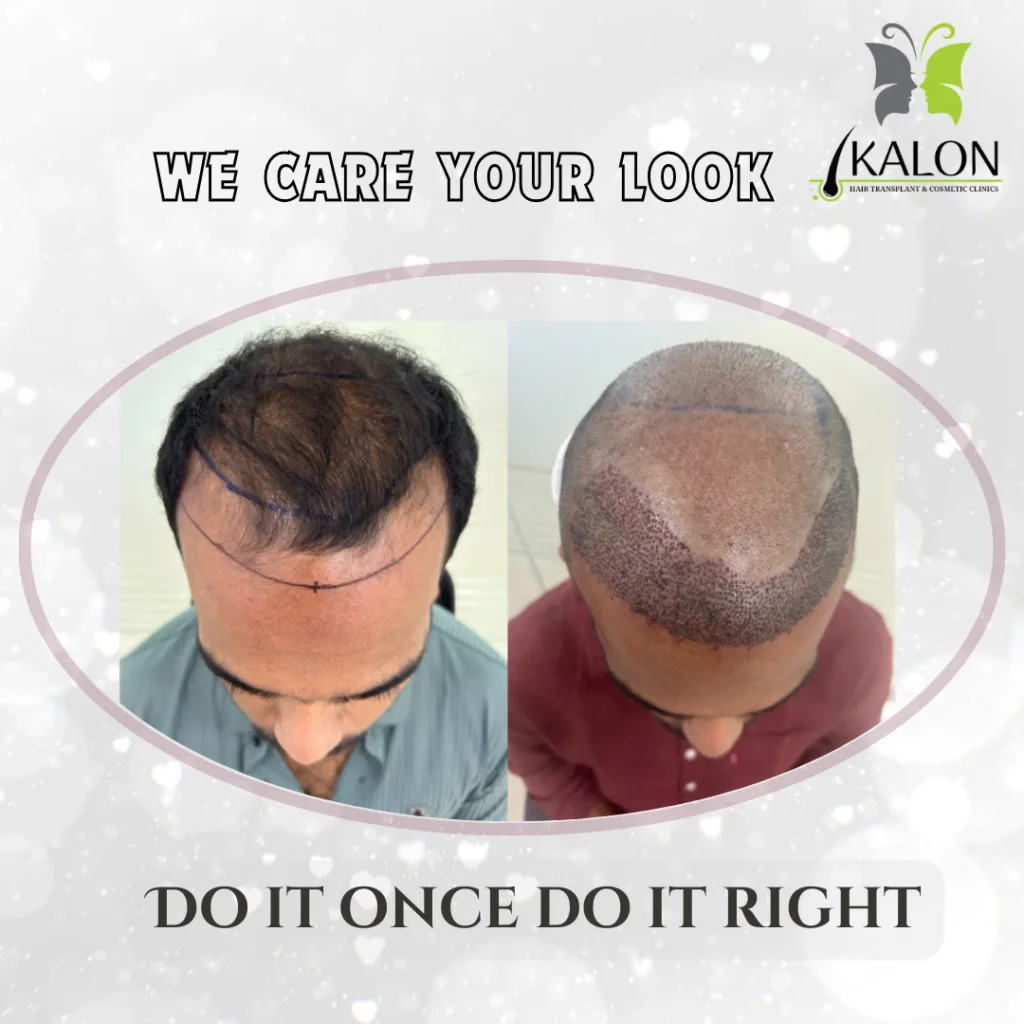 best hair transplant clinic in visakhapatnam