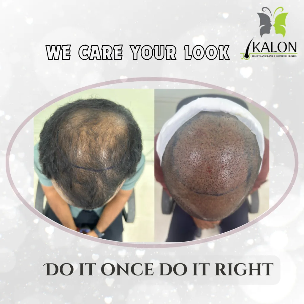 best hair transplant clinic in visakhapatnam
