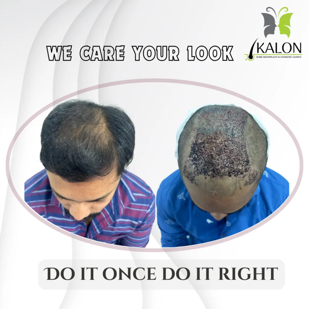 Best Hair Transplant Clinic in Visakhapatnam
