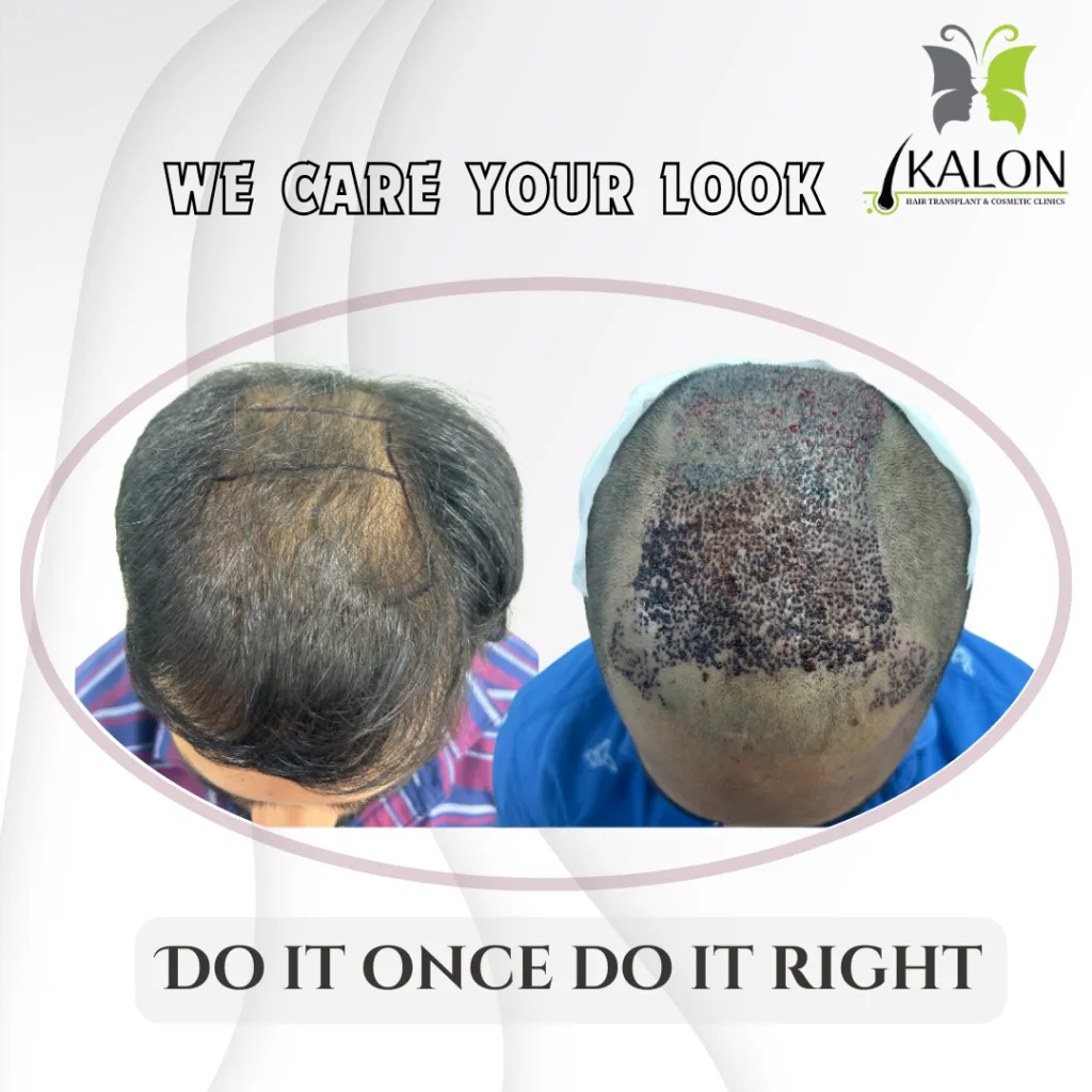 Best Hair Transplant Clinic in Visakhapatnam
