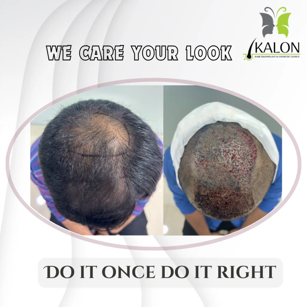 Best Hair Transplant Clinic in Visakhapatnam
