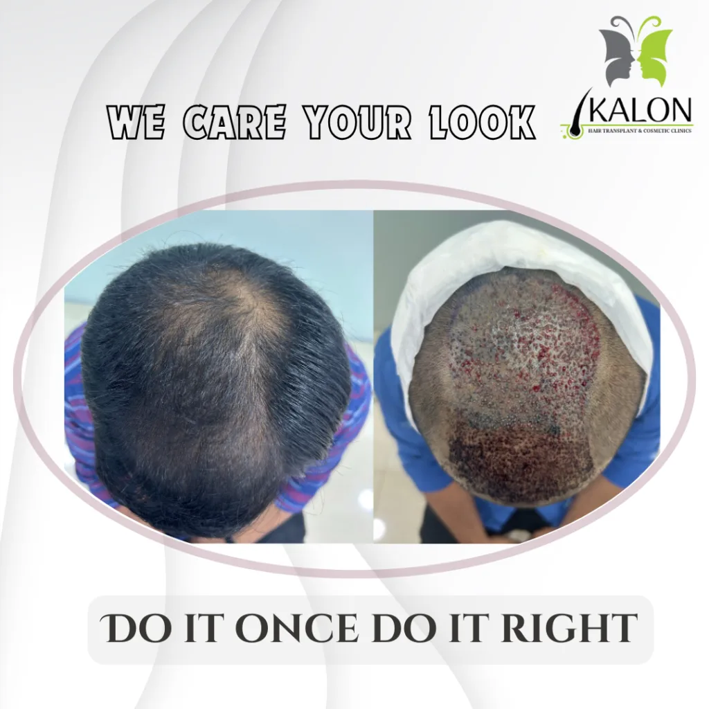 Best Hair Transplant Clinic in Visakhapatnam