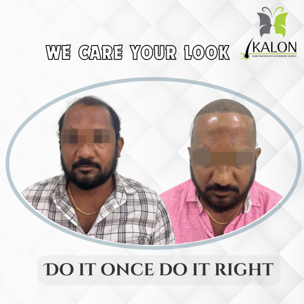 best hair transplant