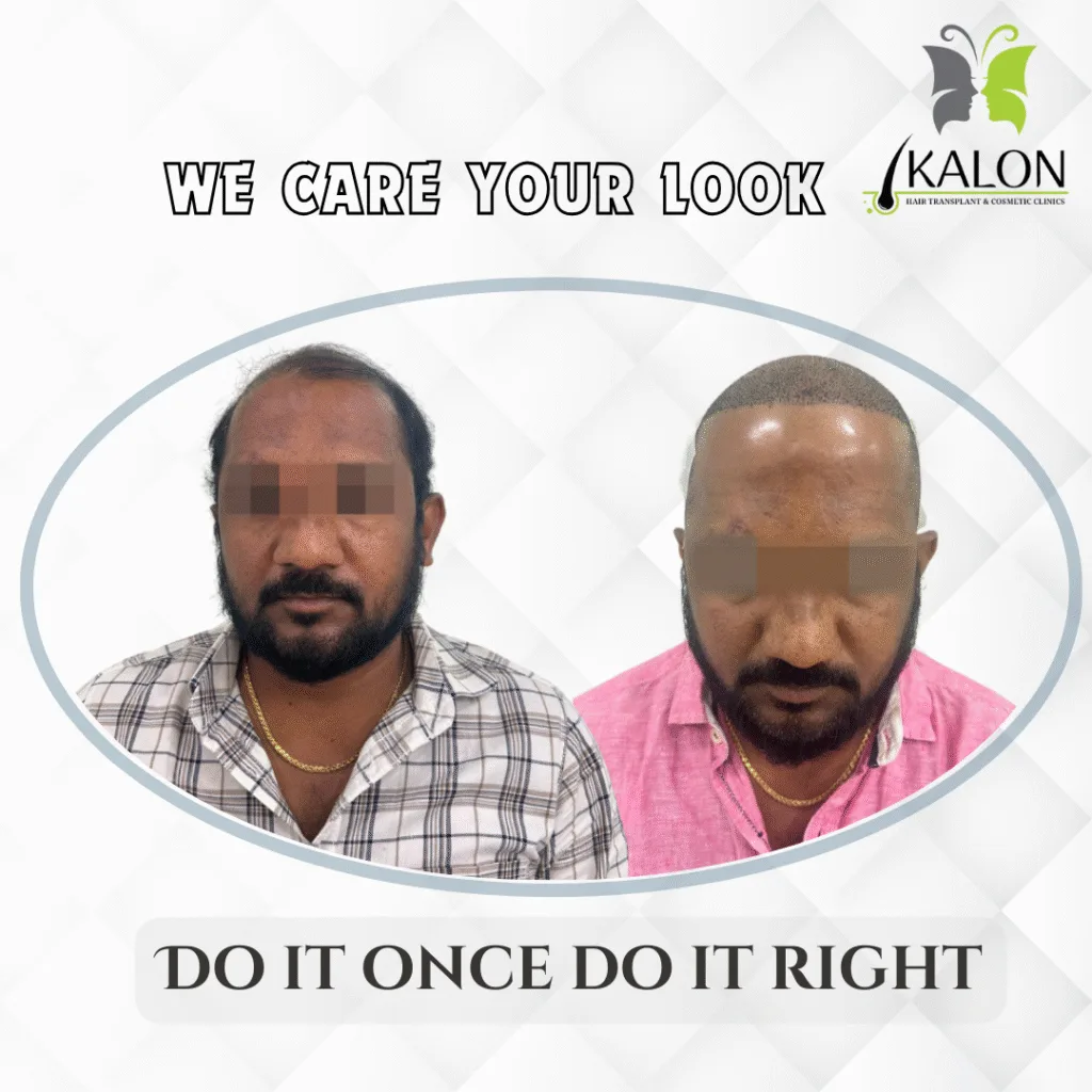 best hair transplant