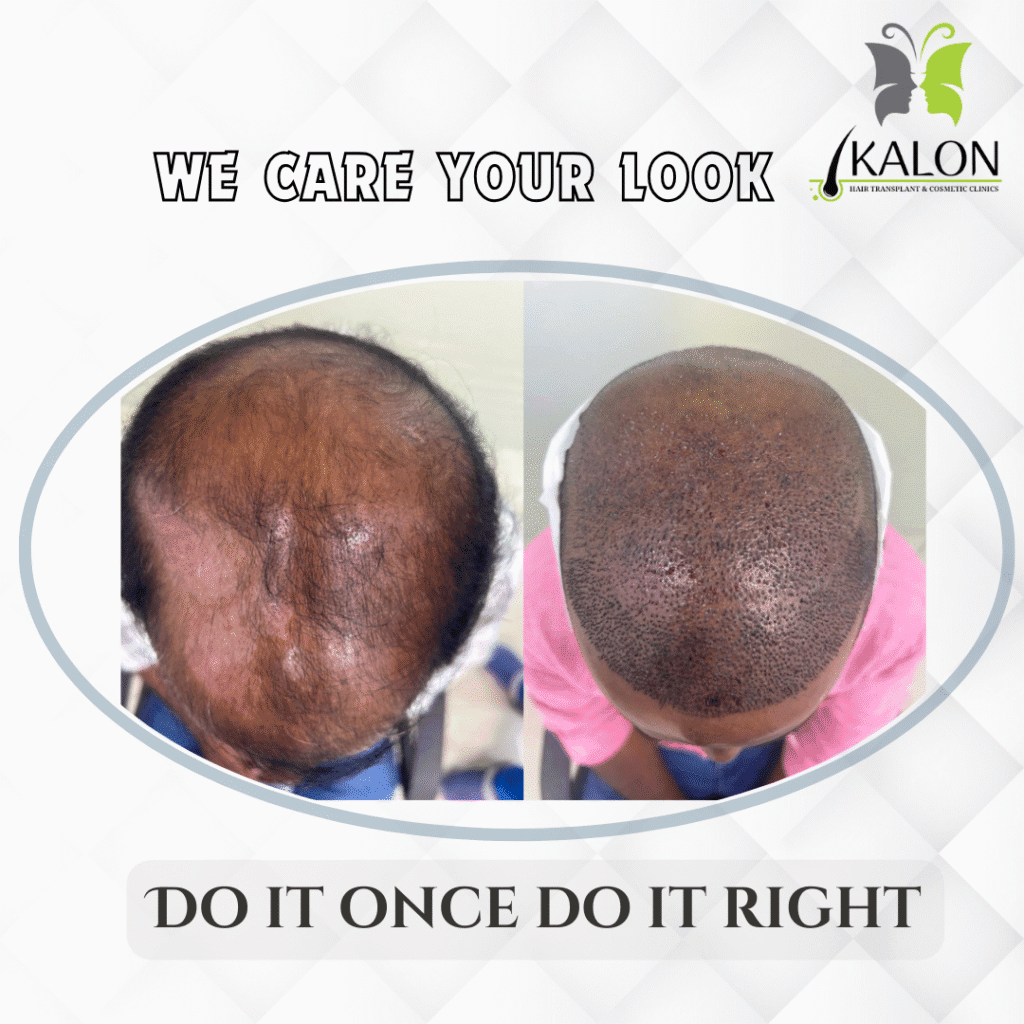 best hair transplant in Visakhapatnam
