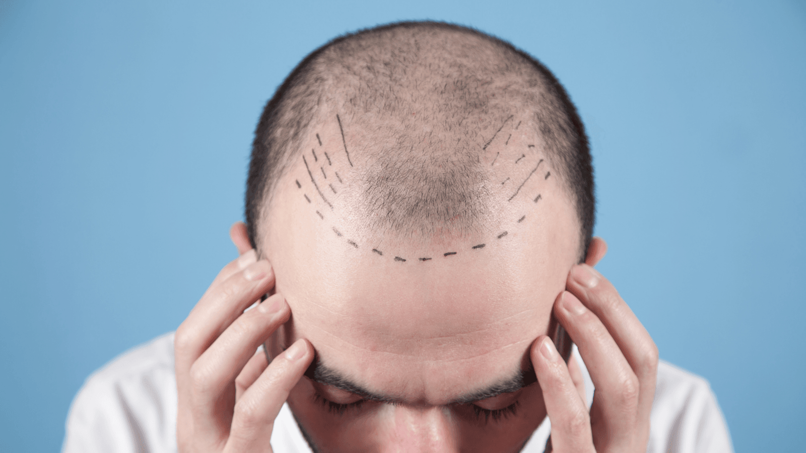 Bio-FUE Hair Transplant