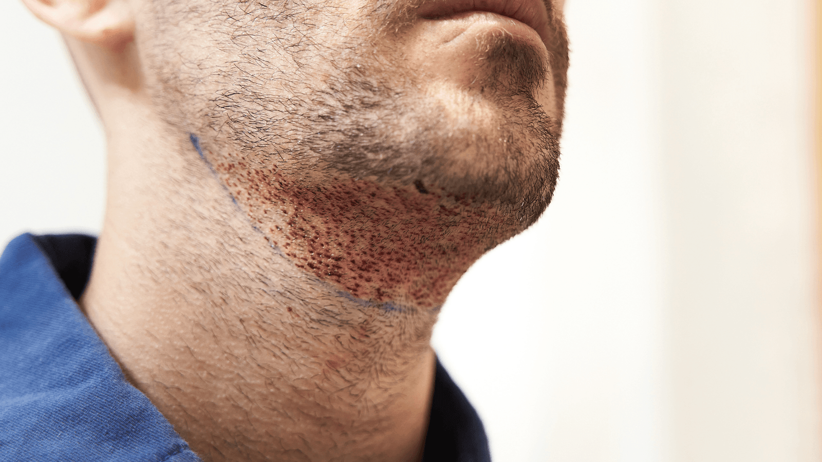 Beard Transplant