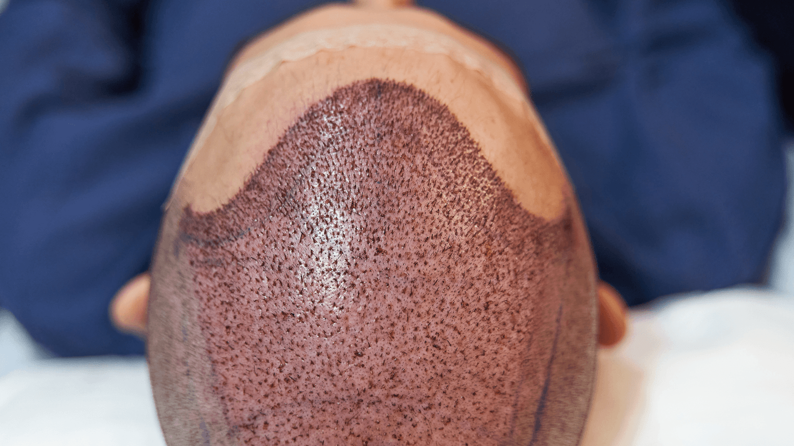 Body Hair Transplant