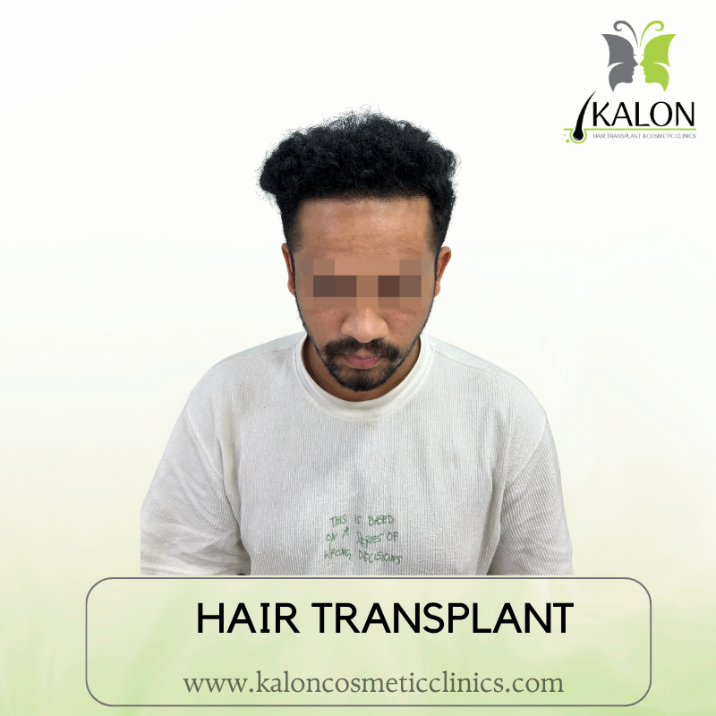 After full coverage hair transplant at Kalon Cosmetic Clinics