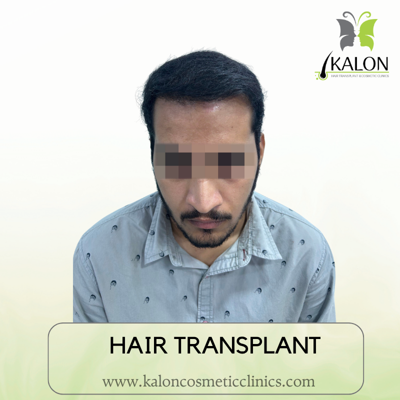 After full coverage hair transplant at Kalon Cosmetic Clinics
