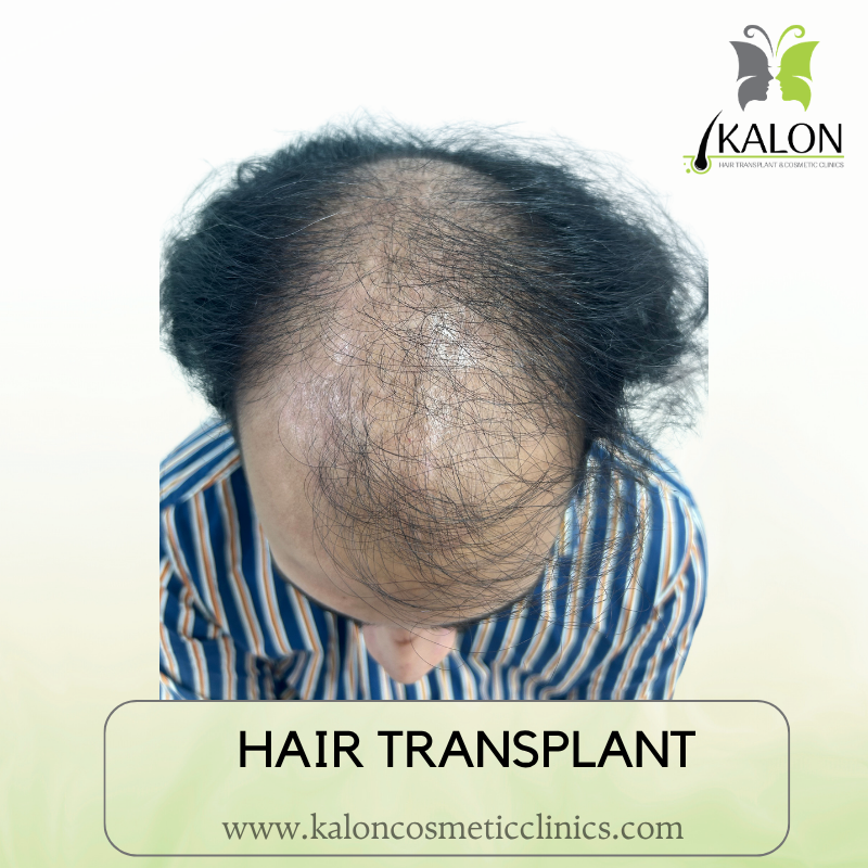 Before full coverage hair transplant at Kalon Cosmetic Clinics