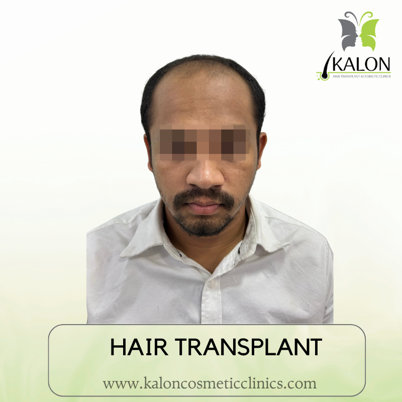 Before full coverage hair transplant at Kalon Cosmetic Clinics