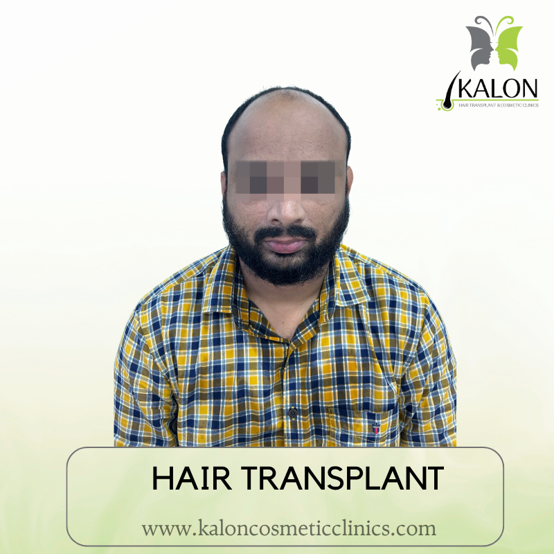 Before full coverage hair transplant at Kalon Cosmetic Clinics