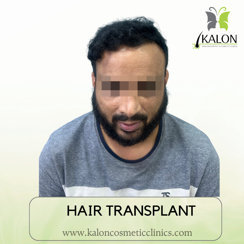 After full coverage hair transplant at Kalon Cosmetic Clinics