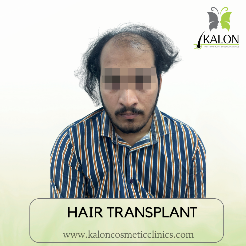 Before full coverage hair transplant at Kalon Cosmetic Clinics