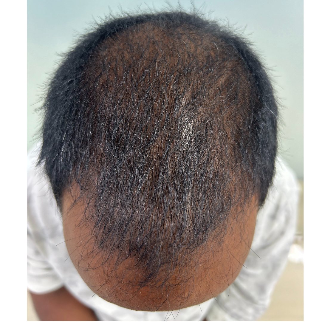Before hair transplant at Kalon Cosmetic Clinics