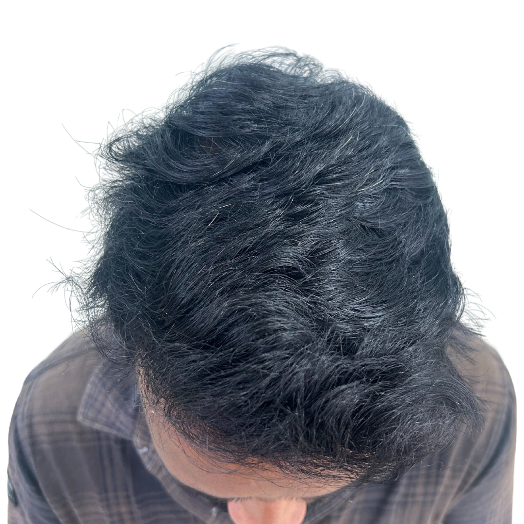 After hair transplant at Kalon Cosmetic Clinics