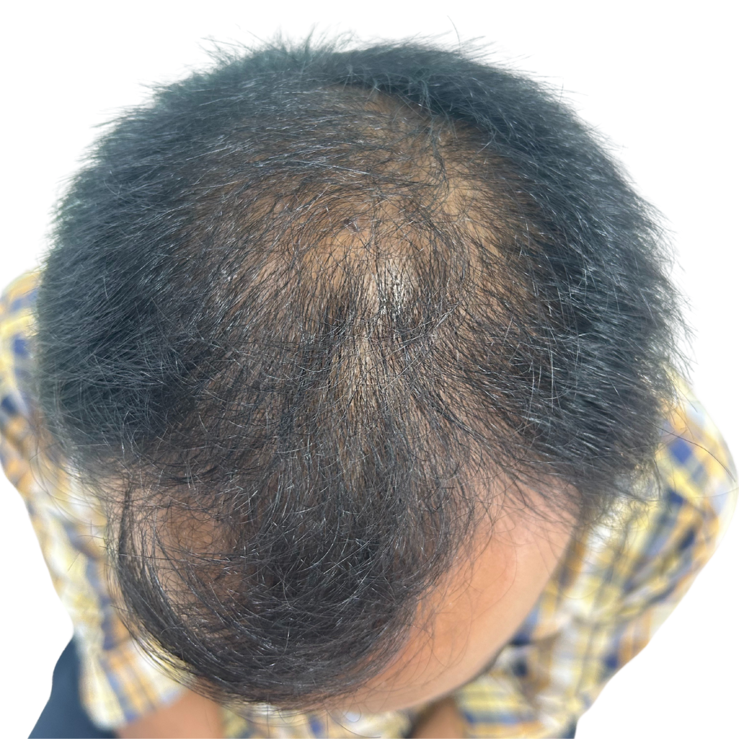 Before hair transplant at Kalon Cosmetic Clinics