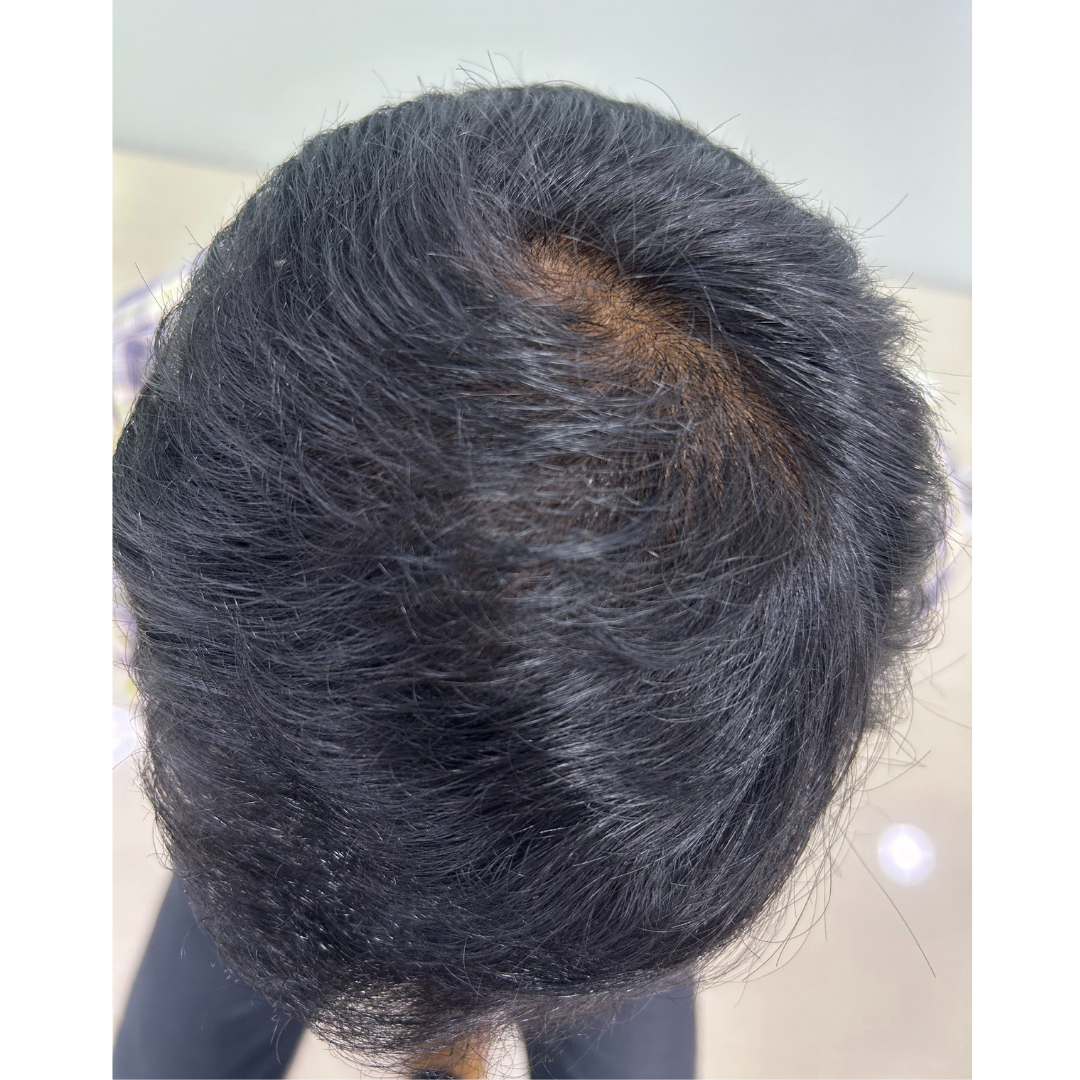 After hair transplant at Kalon Cosmetic Clinics