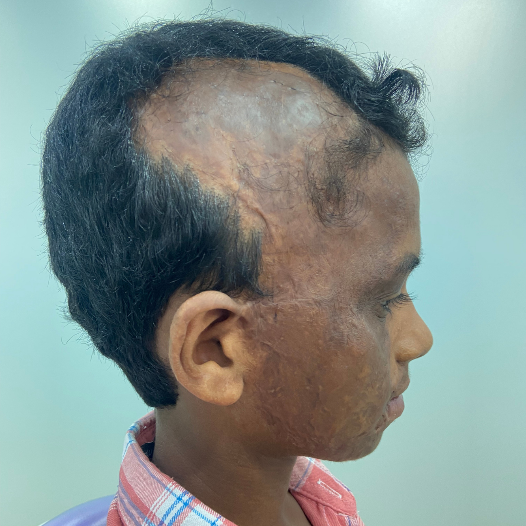 Before burn alopecia hair restoration at Kalon Cosmetic Clinics