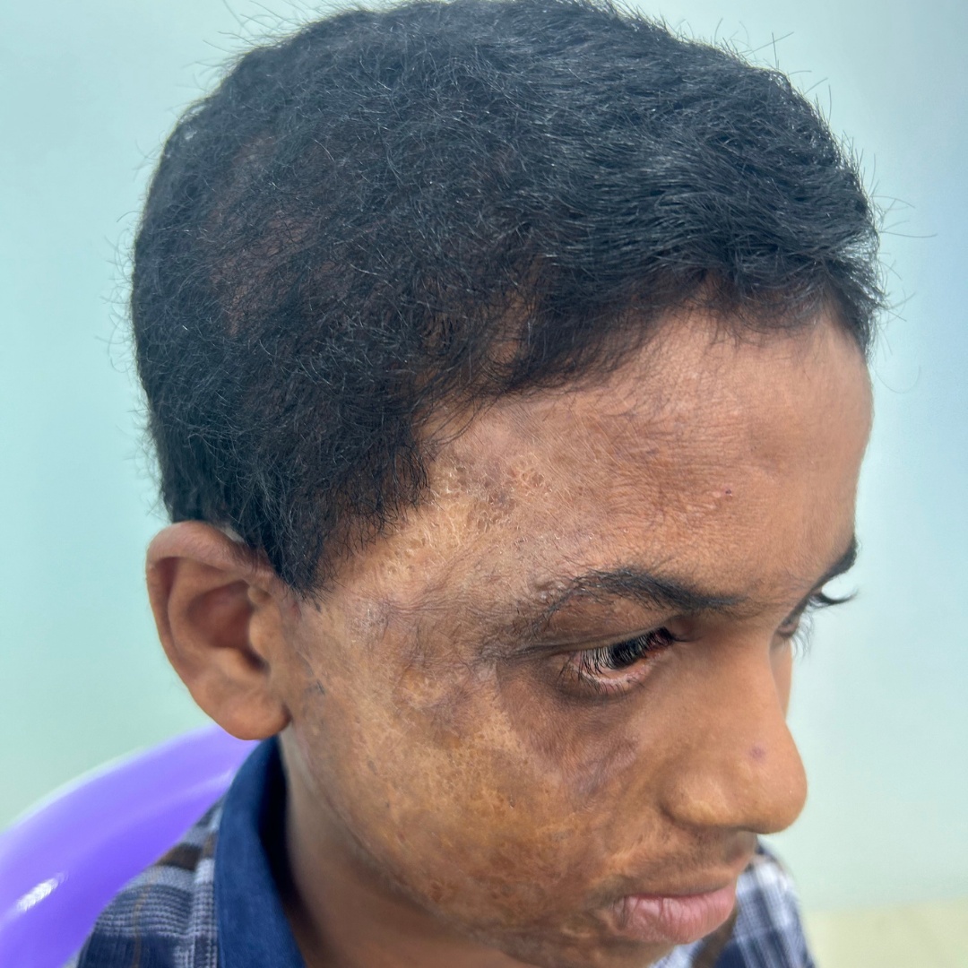 After burn alopecia hair restoration at Kalon Cosmetic Clinics