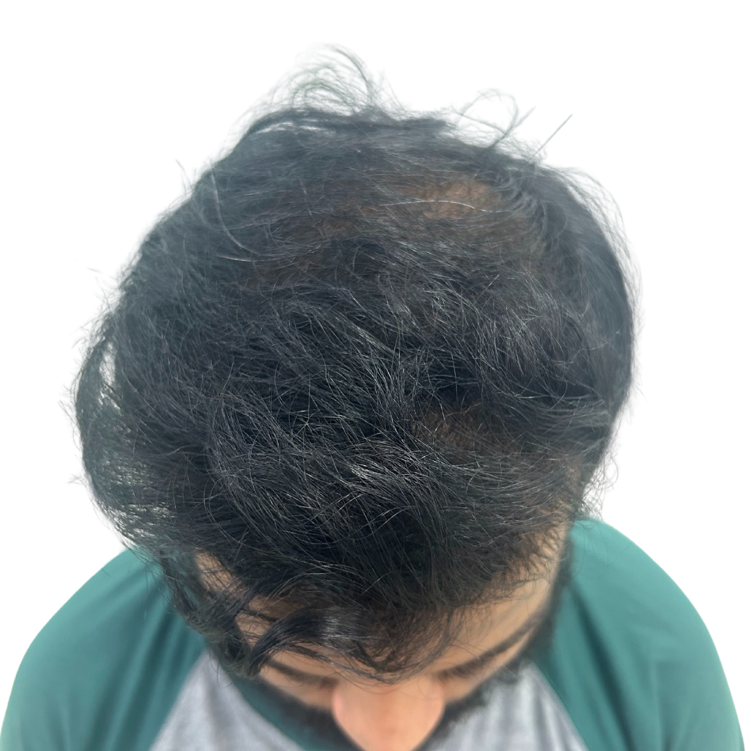 After hair transplant at Kalon Cosmetic Clinics