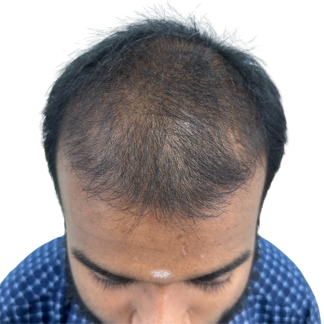 Before hair transplant at Kalon Cosmetic Clinics